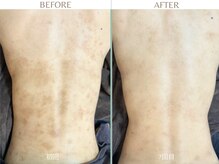 結婚式でドレスを着るためにコツコツ・・・綺麗な背中で本番を♪