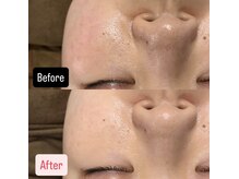 ハイコガオ(HIKOGAO)/ララピール