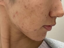 リベル 名古屋(Lebelle:)/ハーブピーリング　名古屋