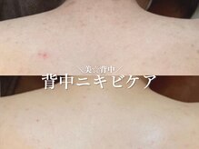 ルアナアイナ 大分/ハーブピーリング(8)