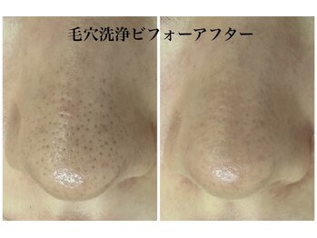 ベラドンナ(Bella Donna)/大人気毛穴洗浄ビフォーアフター