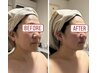 リピーター様/faceラジオ波デラックス/美肌.小顔.むくみ.リフトアップ計80分