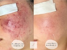リル ビューティー ラボ(LILU BEAUTY LAB)の雰囲気（しっかりとしたカウンセリング・アフターケアのアドバイスまで◎）