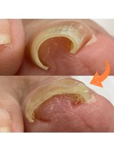 スマートリフト 五反田 大崎店(SMART LIFT)/巻き爪改善施術【大崎/五反田】