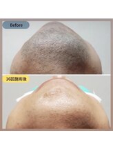 グラン(GRAN)/人気ナンバーワン　ヒゲ脱毛