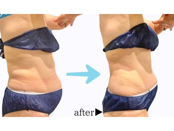 ラリマ(La-lima)/60代女性/下腹のお肉悩み