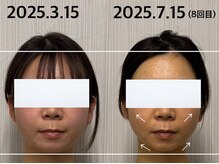 ベール(BEHL)/コルギのBefore After