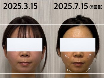 ベール(BEHL)/コルギのBefore After