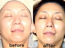 あおいはな(aoihana)/フェイシャルエステ後の効果