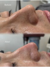 アンノウン(Unknown.)/毛穴洗浄