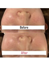 ハイコガオ(HIKOGAO)/ララピール