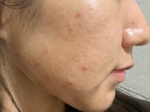 リベル 名古屋(Lebelle:)/ハーブピーリング　名古屋