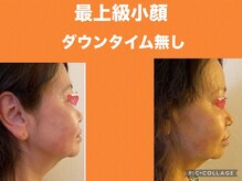 ボディエイジングラボ マハロ(MAHALO)/最上級小顔でハリアップ