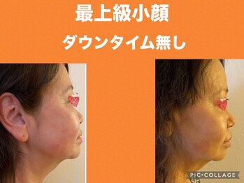 ボディエイジングラボ マハロ(MAHALO)/最上級小顔でハリアップ