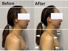 ベール(BEHL)/コルギのBefore After