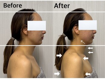 ベール(BEHL)/コルギのBefore After