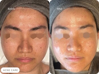 キュレイテッドスキン(CURATED SKIN)/30代.ニキビケア2回目/5回コース