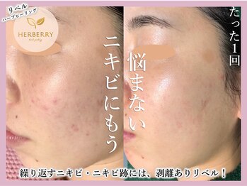 ハーバリー 天王寺(HERBERRY)/ハーブピーリング専門店HERBERRY