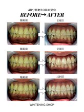 ホワイトニングショップ 茨木店/40分10回/ビフォーアフター