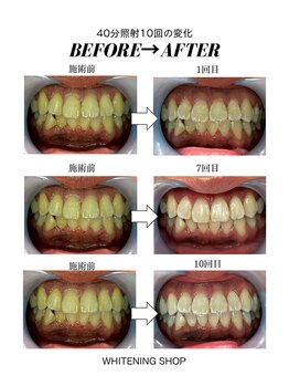 ホワイトニングショップ 茨木店/40分10回/ビフォーアフター