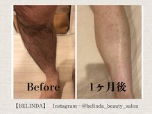 ベリンダ(BELINDA)/脱毛 (認定脱毛講師 在籍サロン)