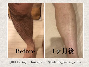 ベリンダ(BELINDA)/脱毛 (認定脱毛講師 在籍サロン)