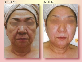 ジュリア オージェ 四条河原町店/ビフォーアフター/イドラリフト