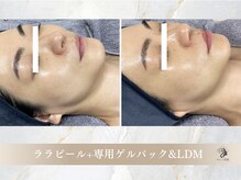 キレイ美肌 北心斎橋店/ララピール/LDM水玉リフティング