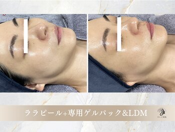 キレイ美肌 北心斎橋店/ララピール/LDM水玉リフティング