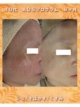 ナイア(naia)/アクアヴィーナス使用症例