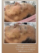 エスプラス エヌプラス(S+/N+)/フェイシャルエステ　ビフォアフ