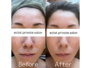 エクレ(eclat)/コルギが苦手な方への小顔術