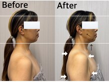 ベール(BEHL)/コルギのBefore After