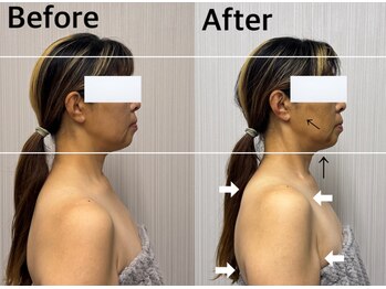 ベール(BEHL)/コルギのBefore After