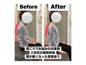 アンティオール 札幌店/20代女性　辛い肩こり/頚部痛