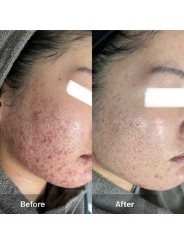 モカ 天王寺店(MOKA)の写真/《天王寺駅徒歩3分》口コミ450件超★評点4.94の実力派ハーブピーリング専門店で本気の肌質改善♪満足度◎