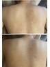 【見られる背中へ♪】くすみ、ざらつき改善お背中ハーブピーリング
