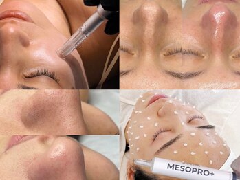 エトレ(ETOLE)の写真/★SNS話題★エステ版ポテンツァ☆スキンジェクションプ口!肌タイプに合わせて美容液を奥まで浸透◎
