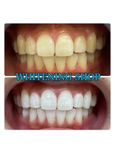 ホワイトニング ショップ 金沢店/効果絶大！！！ホワイトニング