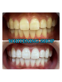 ホワイトニング ショップ 金沢店/効果絶大！！！ホワイトニング