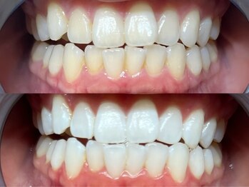 ライトケアサロン 表参道店(Light Care Salon)/セルフホワイトニング