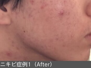 オアシスラグーン(OASIS LAGOON)/ニキビ改善(症例1 after)