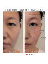 賢者のボディケア/100%人幹細胞上清液導入