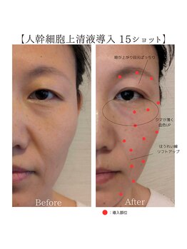賢者のボディケア/100%人幹細胞上清液導入