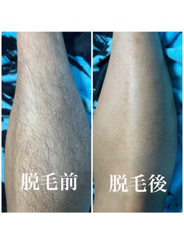 シュガーリングハウスレディ(SugaringHouse LADY)/メンズ脱毛