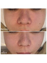 ウィルビューティーサロン(will beauty salon)/クリスティーナハーブピーリング