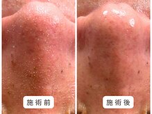 リンド(Lindo)/【毛穴洗浄】毛穴ケア