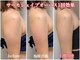 フェムプリュ(femplus)の写真/【燃焼特化痩身サーモシェイプopas★】落ちにくい二の腕やお腹の脂肪に！夏までに間に合う最短結果出し◎
