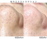 ハリサク