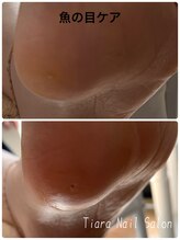 ティアラ(Tiara)/魚の目ケア
